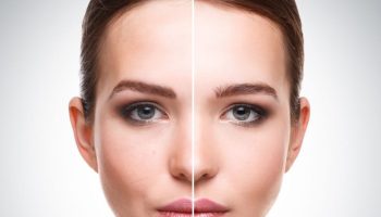 Brow Lift 2