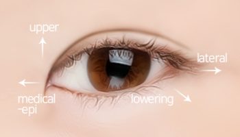 Cantoplasty 4