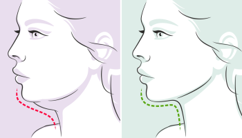 Chin Liposuction 5