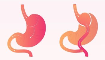 Gastric Bypass