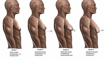 Gynecomastia 3