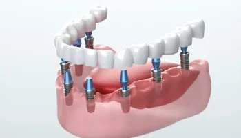Implant 2