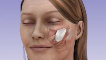 Malar Implants 2