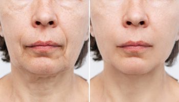 Necklift 5