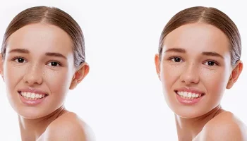 Otoplasty 3