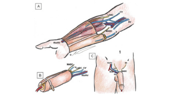 Penis Reconstruction 1