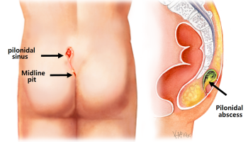 Pilonidal Dimple 1