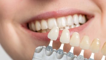 Porcelain Veneer Crown-Implant 2
