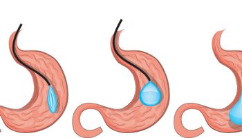 Stomach Balloon (12 months)