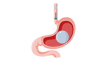 Swallowable Stomach Balloon3