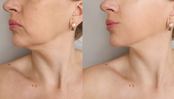 Woman,Double,Chin,After,Treatment