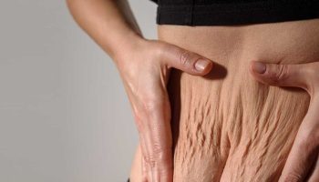 Tummy Tuck 5